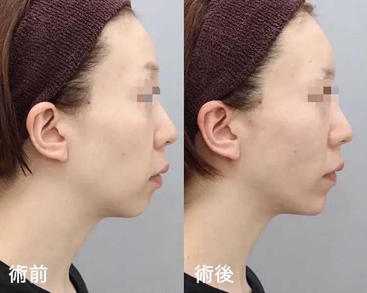 糸リフト+Vシェイプ